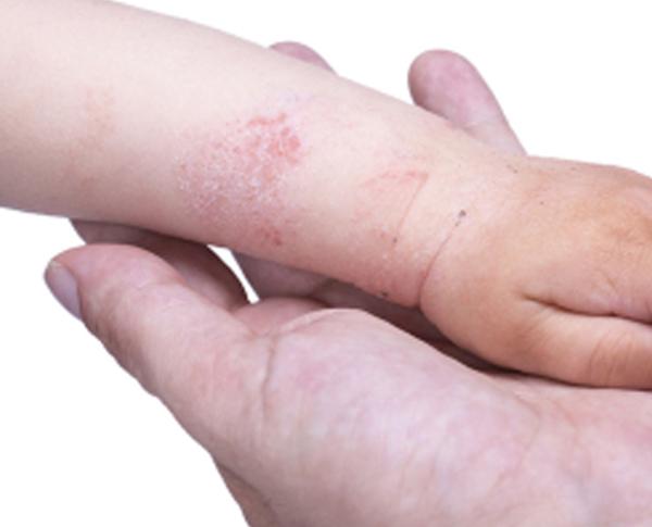 a baby's arm suffering from eczema and needing skin treatment services