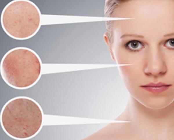 a representation of the skin discolorations that can be treated using limelight facial