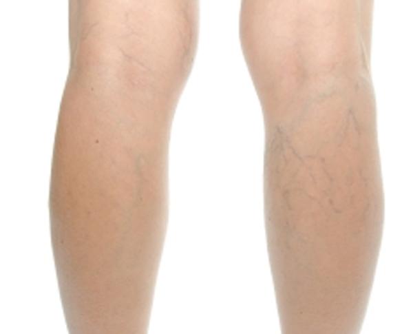 legs with spider veins that have been treated with sclerotherapy