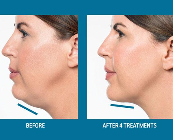 before and after results of kybella injections for chin fat in Beverly Hills