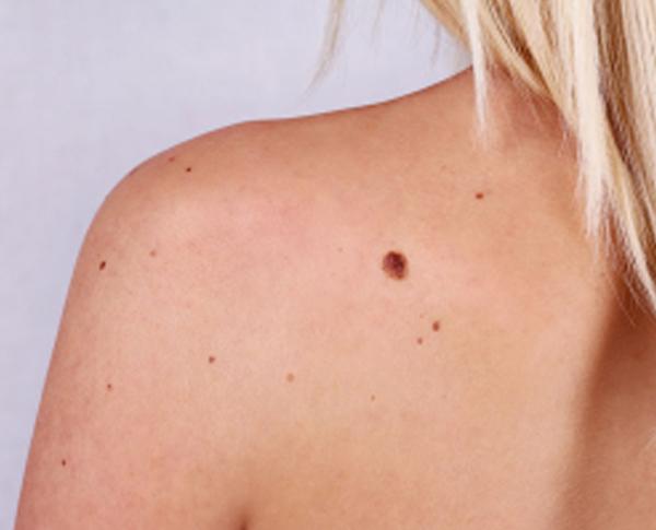 a pre-cancerous mole that should be checked