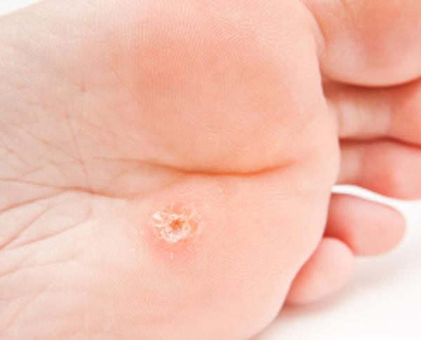 a foot in need of wart treatment in Beverly Hills